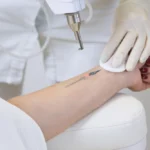 Tattoo Removal Pain