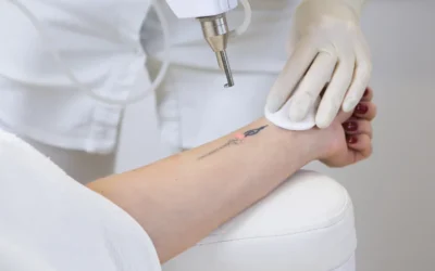 Tattoo Removal Pain